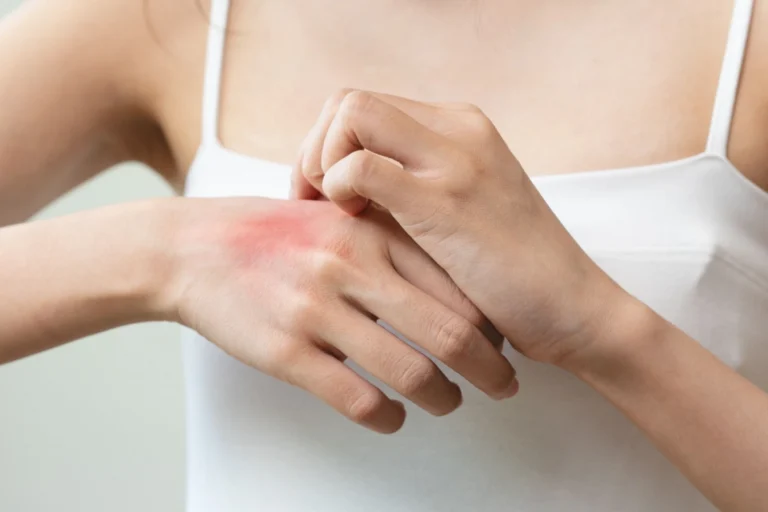 vista delle mani di una donna con pelle sensibile e arrossata